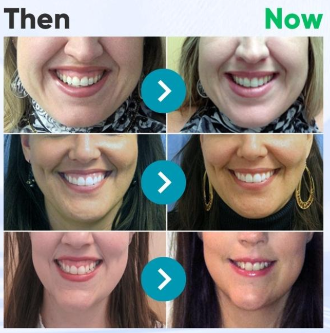 Furzero™ EaseSmile Gums Therapy & Pain Relief Probiotics Bee Venom Chicles 60PCS